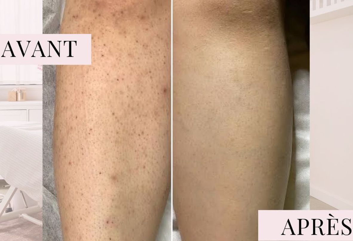 Jambes : moins de poils incarnés et de points noirs